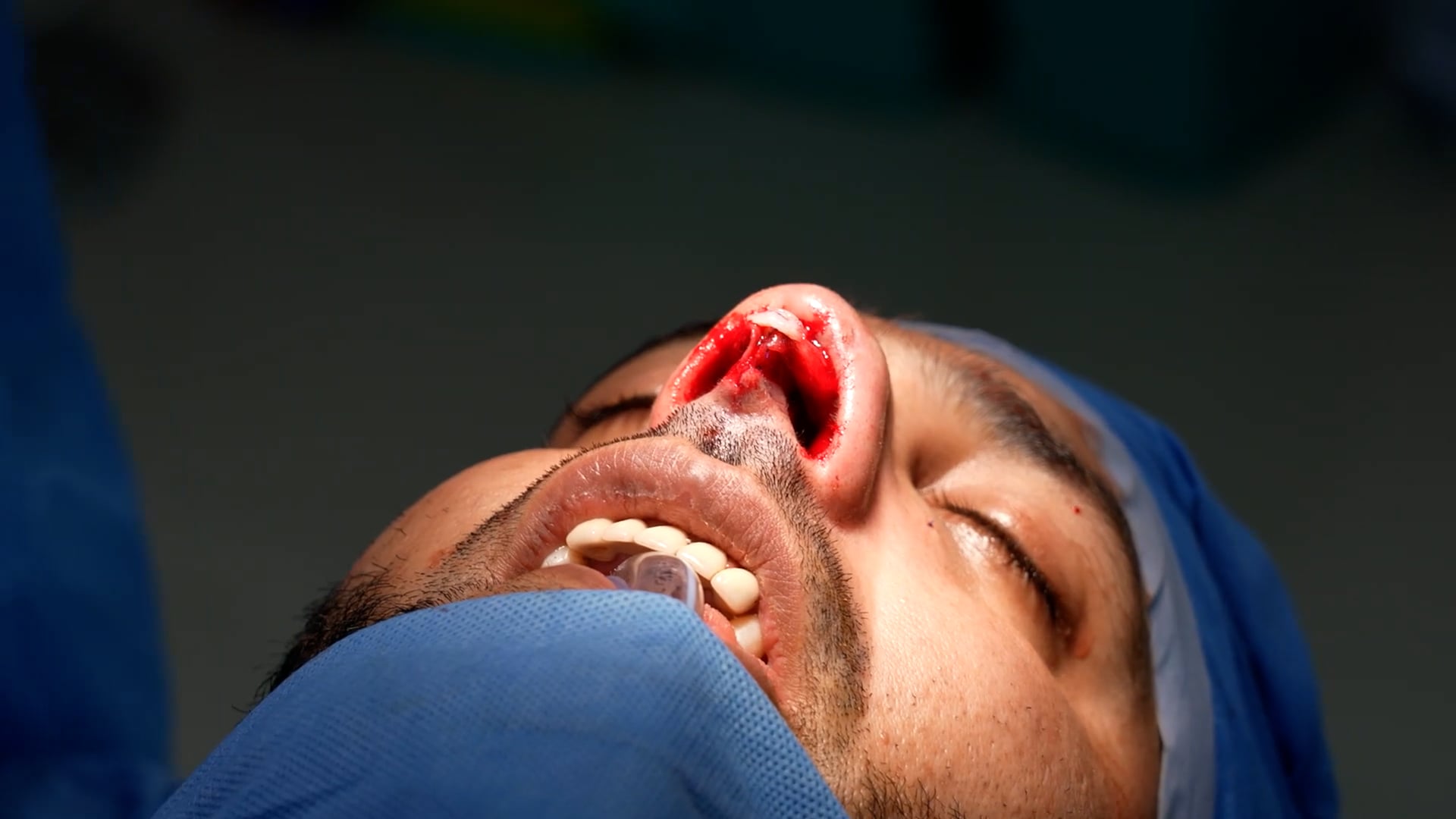 rhinoplasty